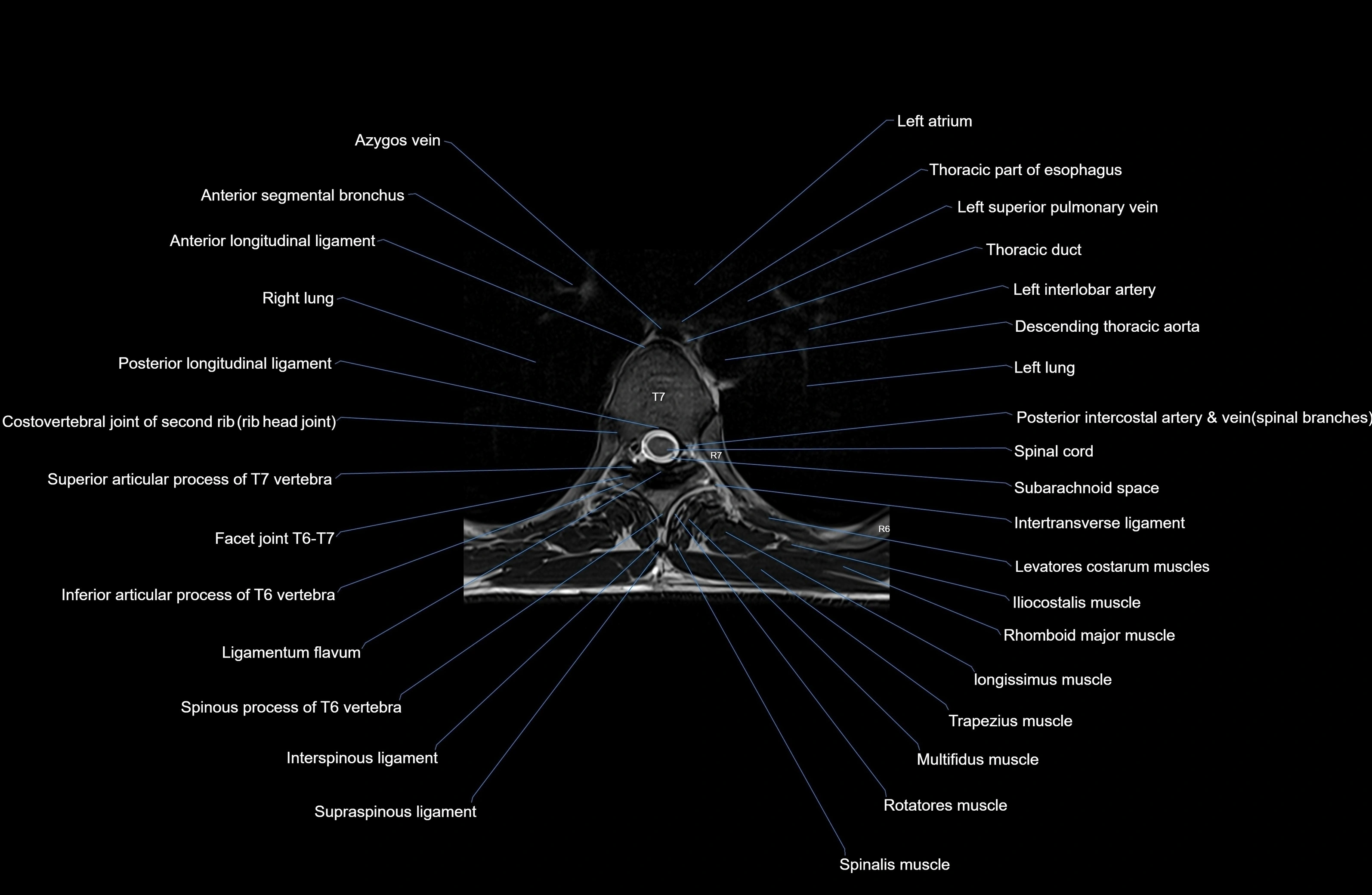MRI thoracic spine axial  cross sectional anatomy 3T radiology  image-img-00001-00043.webp